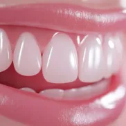 Gummy smile
